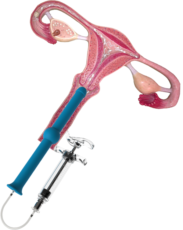 At-Home Insemination Kit for Couples - Multiple Attempts - Image 3
