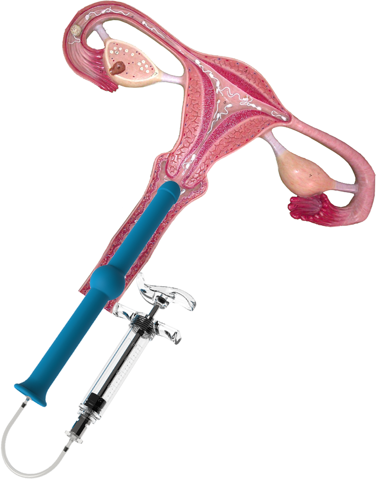 Home Insemination Kit: Professional Fertility Combo - Image 2