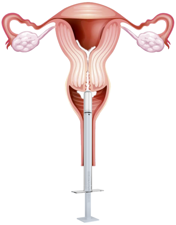 At-Home Insemination Kit - Couples Kit | MakeAMom - Image 4