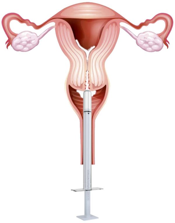 At-Home Insemination Kit: Conception Essentials - Unlimited Attempts - Image 3